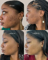 The truth about hyperpigmentation and how to treat dark spots
