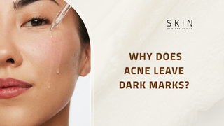 Why Does Acne Leave Dark Marks? Understanding Post-Acne Hyperpigmentation