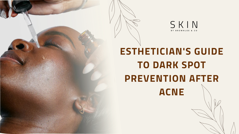 Esthetician's Guide to Dark Spot Prevention After Acne