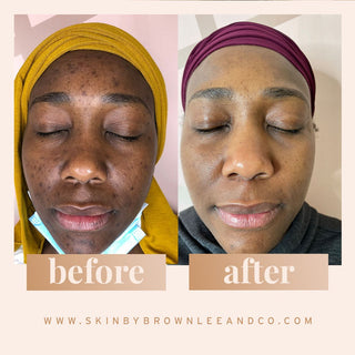 The truth about hyperpigmentation and how to treat dark spots - Skin by Brownlee & Co.