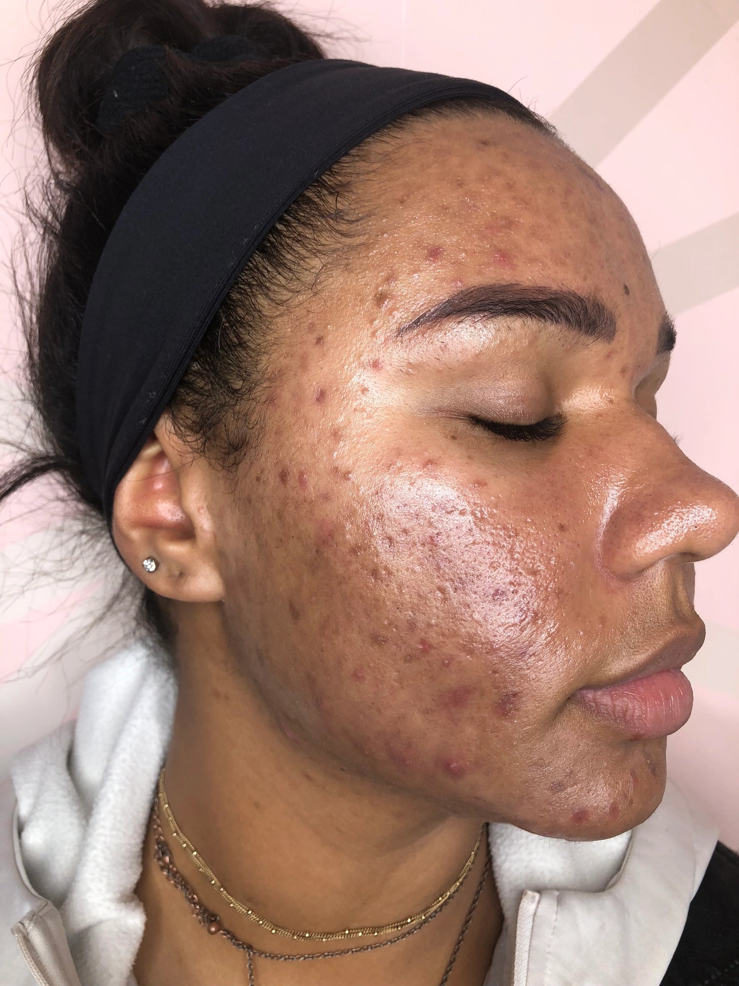 From a multitude of blemishes to noticeably fewer, revealing clearer, more radiant skin.