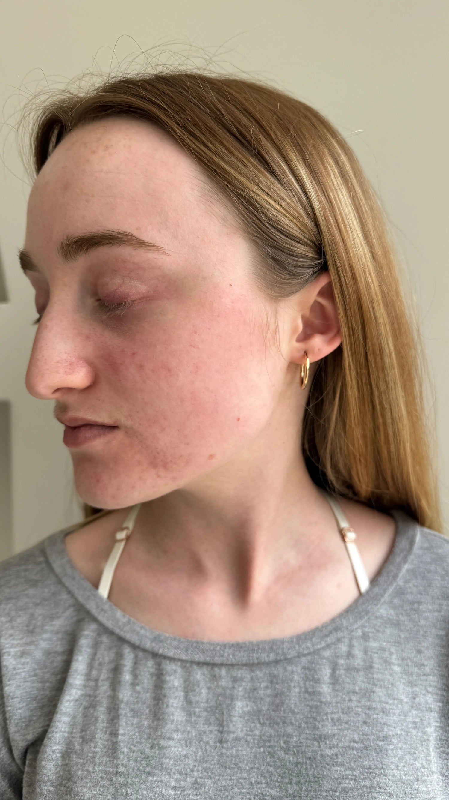 Transform your skin with our expert skincare solutions. Witness remarkable results and achieve your best complexion. See the before-and-after difference!