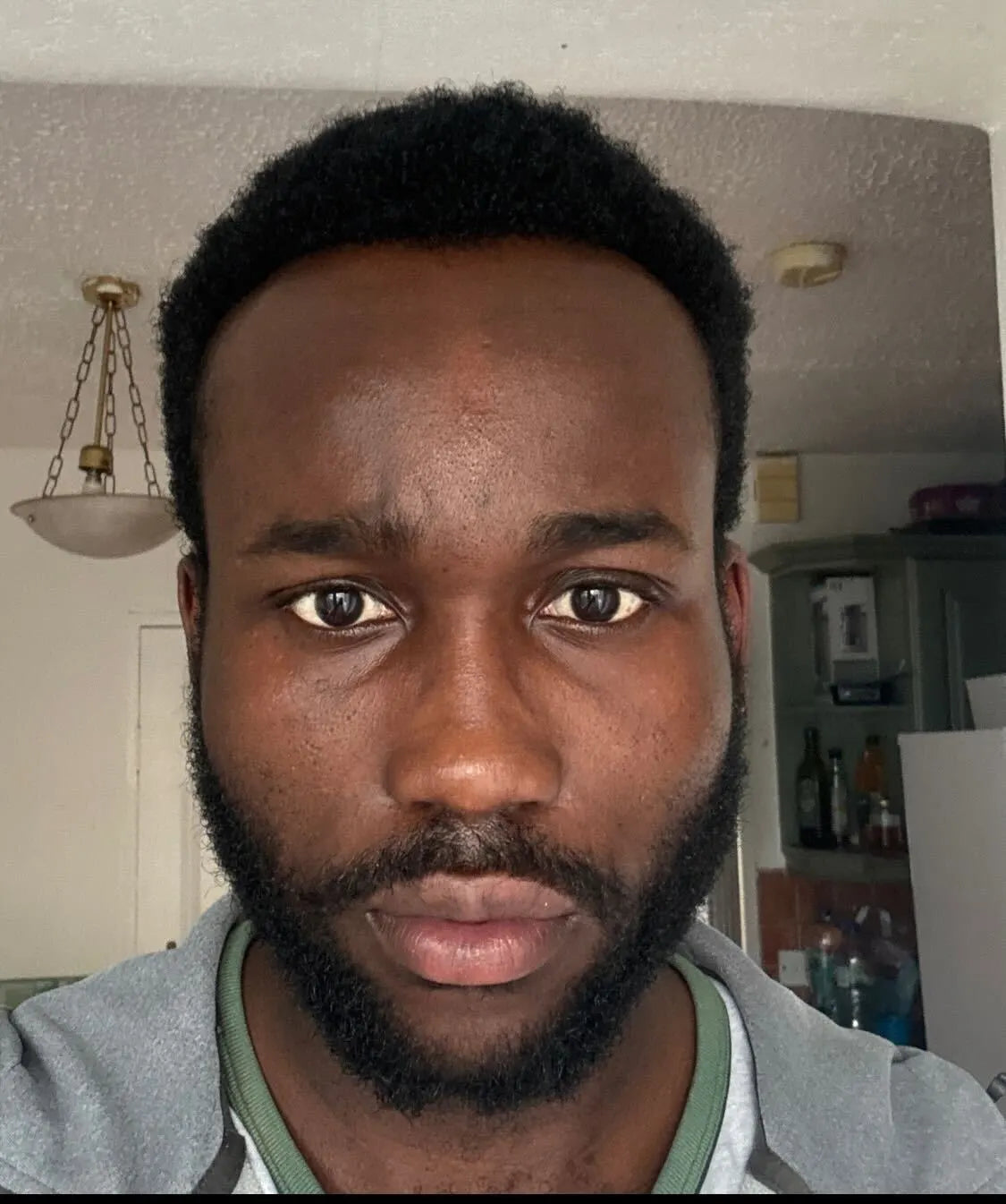 Transforming Skin: A Boy's Journey

See the remarkable difference skincare can make! This before-and-after showcases a young man's journey to healthier, more radiant skin. Witness the positive impact of a consistent skincare routine, highlighting the power of targeted treatments and gentle care.