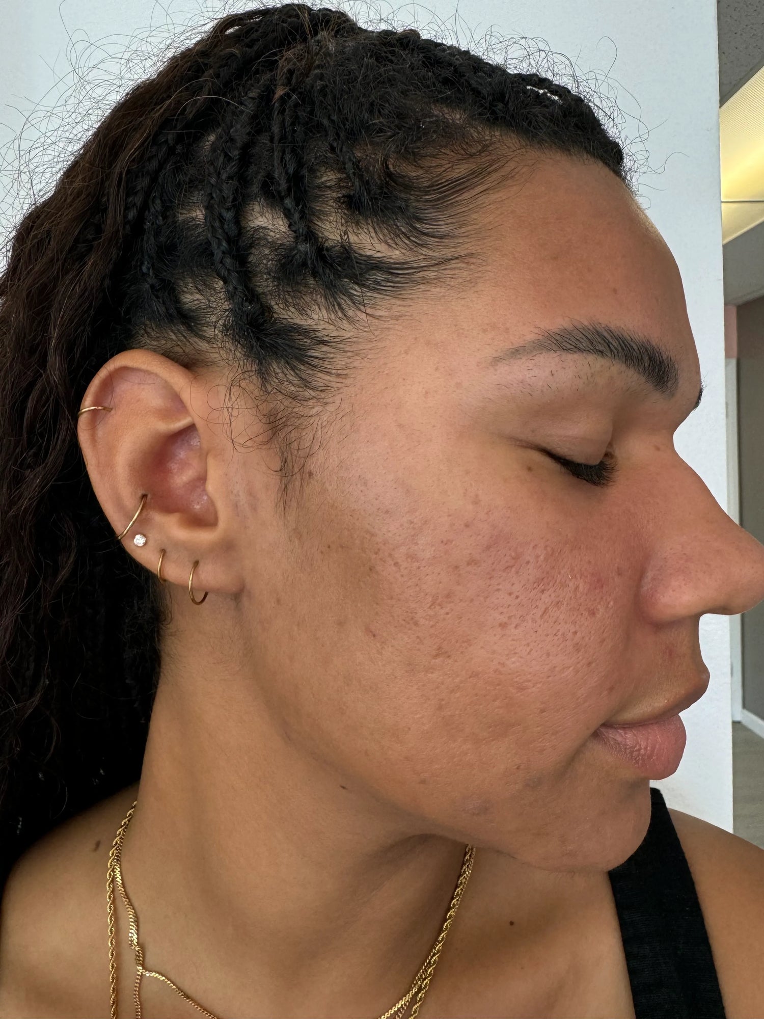 From a multitude of blemishes to noticeably fewer imperfections.