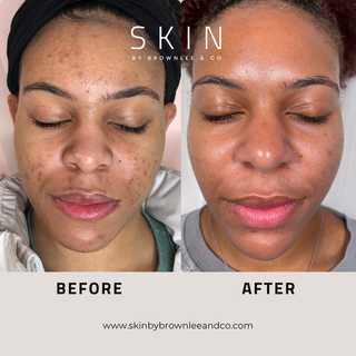 Vanishing Serum 10 - Intensive Prevention Serum for Dark Spots & Acne | Wholesale