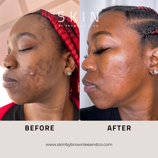 Breakout Banisher Overnight Treatment Gel 5 - Benzoyl Peroxide Spot Treatment