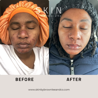 Acne Treatment Kit - Complete At Home Acne Fighting System
