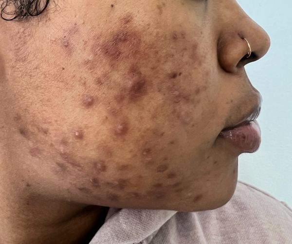 Hormonal & perimenopause
