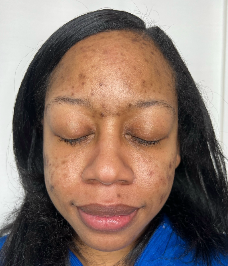 Before treatment