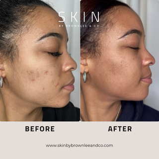 Acne Treatment Kit - Complete At Home Acne Fighting System