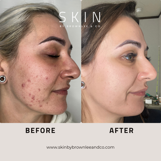 Acne Treatment Kit - Complete At Home Acne Fighting System