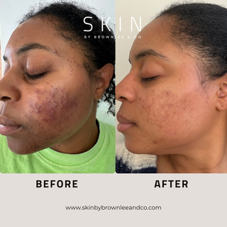 Vanishing Serum 10 - Intensive Prevention Serum for Dark Spots & Acne | Wholesale