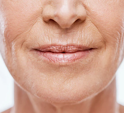 Fine lines & wrinkles