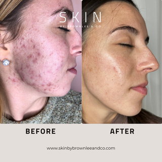 Breakout Banisher Overnight Treatment Gel 10 - Maximum Strength Benzoyl Peroxide Acne Treatment