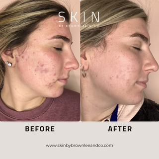Vanishing Serum 10 - Intensive Prevention Serum for Dark Spots & Acne | Wholesale