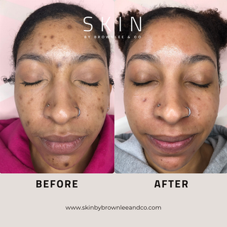 Radiant Renewal A - Retinol Serum for Anti Aging & Texture