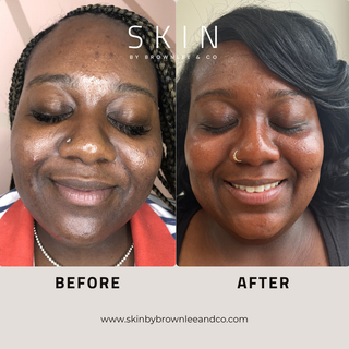 Vanishing Serum 5 - Gentle Prevention Serum for Dark Spots & Inflammation | Wholesale